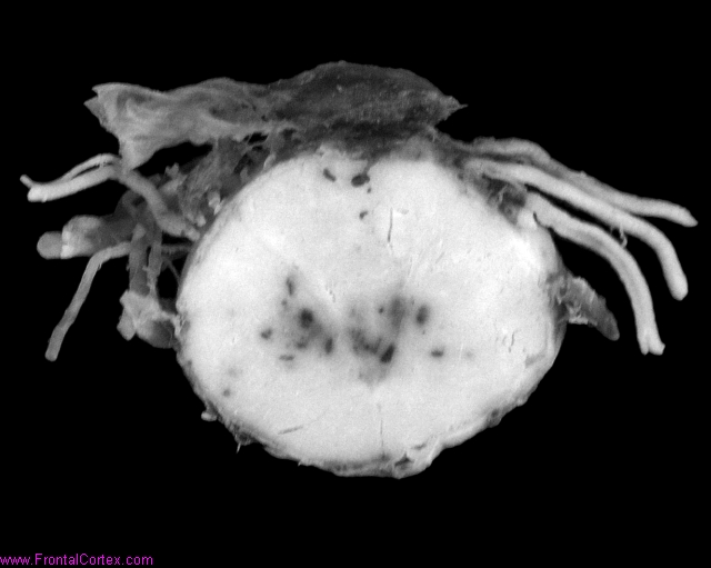 Petechial intramedullary hemorrhages in a patient with acute leukemia